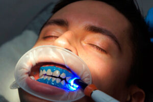 Способы отбеливания зубов в стоматологии