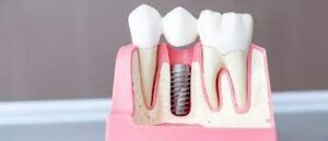 Импланты Snucone для зубов